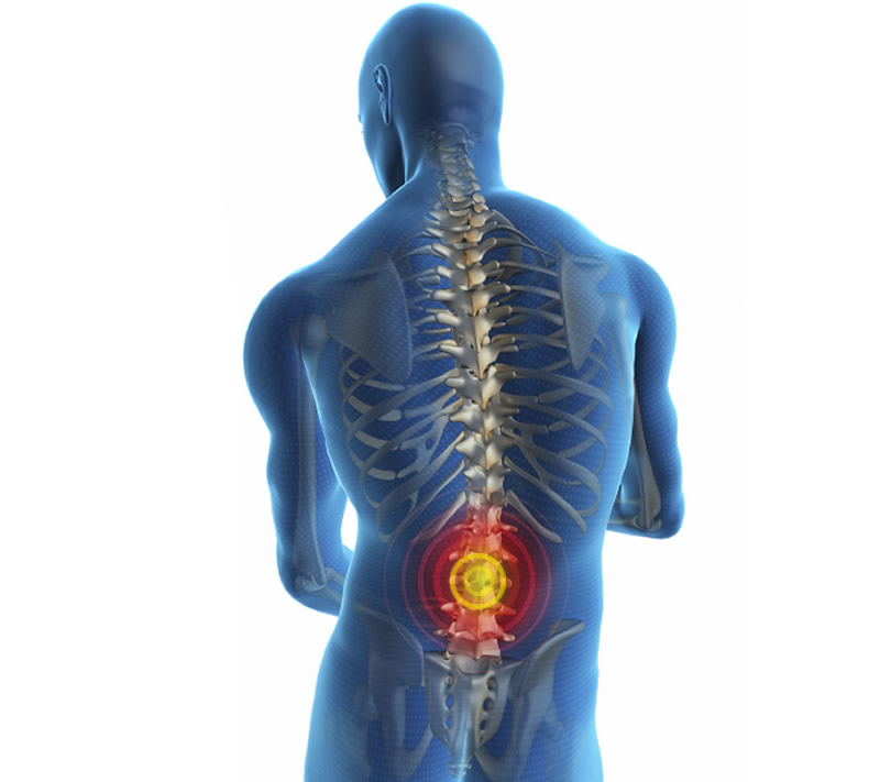 Hacamat Bel Fıtığına İyi Gelir mi? - İzmir Hacamat | Dr. Mehmet Özkent